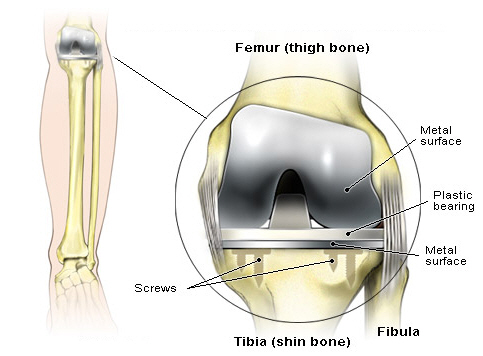 Componentes de la protesis